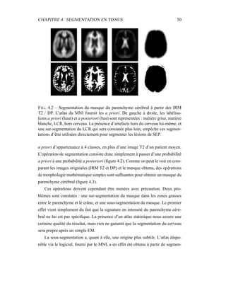 CHAPITRE 4. SEGMENTATION EN TISSUS 50
FIG. 4.2 – Segmentation du masque du parenchyme cérébral à partir des IRM
T2 / DP. L’atlas du MNI fournit les a priori. De gauche à droite, les labélisa-
tions a priori (haut) et a posteriori (bas) sont représentées : matière grise, matière
blanche, LCR, hors cerveau. La présence d’artefacts hors du cerveau lui-même, et
une sur-segmentation du LCR qui sera constatée plus loin, empêche ces segmen-
tations d’être utilisées directement pour segmenter les lésions de SEP.
a priori d’appartenance à 4 classes, en plus d’une image T2 d’un patient moyen.
L’opération de segmentation consiste donc simplement à passer d’une probabilité
a priori à une probabilité a posteriori (ﬁgure 4.2). Comme on peut le voir en com-
parant les images originales (IRM T2 et DP) et le masque obtenu, des opérations
de morphologie mathématique simples sont sufﬁsantes pour obtenir un masque du
parenchyme cérébral (ﬁgure 4.3).
Ces opérations doivent cependant être menées avec précaution. Deux pro-
blèmes sont constatés : une sur-segmentation du masque dans les zones grasses
entre le parenchyme et le crâne, et une sous-segmentation du masque. Le premier
effet vient simplement du fait que la signature en intensité du parenchyme céré-
bral ne lui est pas spéciﬁque. La présence d’un atlas statistique nous assure une
certaine qualité du résultat, mais rien ne garantit que la segmentation du cerveau
sera propre après un simple EM.
La sous-segmentation a, quant à elle, une origine plus subtile. L’atlas dispo-
nible via le logiciel, fourni par le MNI, a en effet été obtenu à partir de segmen-
 
