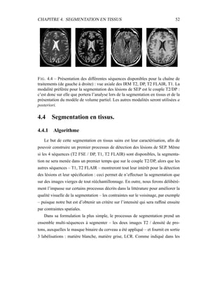 CHAPITRE 4. SEGMENTATION EN TISSUS 52
FIG. 4.4 – Présentation des différentes séquences disponibles pour la chaîne de
traitements (de gauche à droite) : vue axiale des IRM T2, DP, T2 FLAIR, T1. La
modalité préférée pour la segmentation des lésions de SEP est le couple T2/DP :
c’est donc sur elle que portera l’analyse lors de la segmentation en tissus et de la
présentation du modèle de volume partiel. Les autres modalités seront utilisées a
posteriori.
4.4 Segmentation en tissus.
4.4.1 Algorithme
Le but de cette segmentation en tissus sains est leur caractérisation, aﬁn de
pouvoir construire un premier processus de détection des lésions de SEP. Même
si les 4 séquences (T2 FSE / DP, T1, T2 FLAIR) sont disponibles, la segmenta-
tion ne sera menée dans un premier temps que sur le couple T2/DP, alors que les
autres séquences – T1, T2 FLAIR – montreront tout leur intérêt pour la détection
des lésions et leur spéciﬁcation : ceci permet de n’effectuer la segmentation que
sur des images vierges de tout rééchantillonnage. En outre, nous ferons délibéré-
ment l’impasse sur certains processus décrits dans la littérature pour améliorer la
qualité visuelle de la segmentation – les contraintes sur le voisinage, par exemple
– puisque notre but est d’obtenir un critère sur l’intensité qui sera rafﬁné ensuite
par contraintes spatiales.
Dans sa formulation la plus simple, le processus de segmentation prend un
ensemble multi-séquences à segmenter – les deux images T2 / densité de pro-
tons, auxquelles le masque binaire du cerveau a été appliqué – et fournit en sortie
3 labélisations : matière blanche, matière grise, LCR. Comme indiqué dans les
 