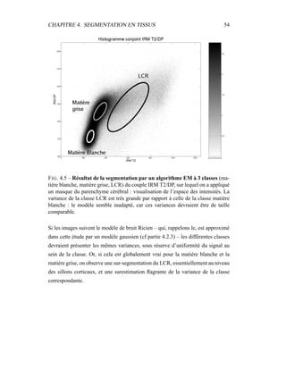 CHAPITRE 4. SEGMENTATION EN TISSUS 54
FIG. 4.5 – Résultat de la segmentation par un algorithme EM à 3 classes (ma-
tière blanche, matière grise, LCR) du couple IRM T2/DP, sur lequel on a appliqué
un masque du parenchyme cérébral : visualisation de l’espace des intensités. La
variance de la classe LCR est très grande par rapport à celle de la classe matière
blanche : le modèle semble inadapté, car ces variances devraient être de taille
comparable.
Si les images suivent le modèle de bruit Ricien – qui, rappelons le, est approximé
dans cette étude par un modèle gaussien (cf partie 4.2.3) – les différentes classes
devraient présenter les mêmes variances, sous réserve d’uniformité du signal au
sein de la classe. Or, si cela est globalement vrai pour la matière blanche et la
matière grise, on observe une sur-segmentation du LCR, essentiellement au niveau
des sillons corticaux, et une surestimation ﬂagrante de la variance de la classe
correspondante.
 