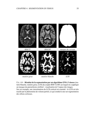 CHAPITRE 4. SEGMENTATION EN TISSUS 55
IRM T2 IRM DP masque du cerveau
matière grise matière blanche LCR
FIG. 4.6 – Résultat de la segmentation par un algorithme EM à 3 classes (ma-
tière blanche, matière grise, LCR) du couple IRM T2/DP, sur lequel on a appliqué
un masque du parenchyme cérébral : visualisation de l’espace des images.
Sur cet exemple, une surestimation du LCR cortical est constaté : le LCR est très
touché par le phénomène de volume partiel, ce qui conduit à une sur-segmentation
des sillons corticaux.
 