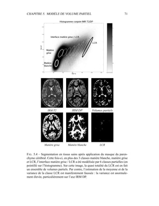 CHAPITRE 5. MODÈLE DE VOLUME PARTIEL 71
IRM T2 IRM DP Volumes partiels
Matière grise Matière blanche LCR
FIG. 5.4 – Segmentation en tissus sains après application du masque du paren-
chyme cérébral. Cette fois-ci, en plus des 3 classes matière blanche, matière grise
et LCR, l’interface matière grise / LCR a été modélisée par 6 classes partielles (en
pointillé sur l’histogramme). Sur cette image, la quasi totalité du LCR est en fait
un ensemble de volumes partiels. Par contre, l’estimation de la moyenne et de la
variance de la classe LCR est manifestement faussée : la variance est anormale-
ment élevée, particulièrement sur l’axe IRM DP.
 