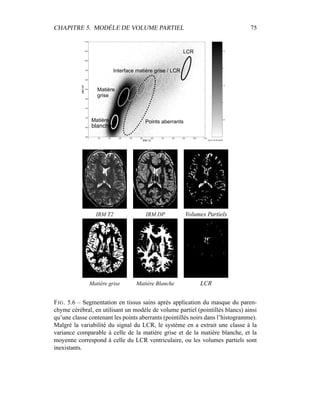 CHAPITRE 5. MODÈLE DE VOLUME PARTIEL 75
0.5
1
1.5
2
2.5
IRM T2
IRMDP
0 100 200 300 400 500 600 700 800 900 1000 1100
600
650
700
750
800
850
900
950
1000
1050
1100
Matière
blanche
Points aberrants
Interface matière grise / LCR
Matière
grise
LCR
log du nb de points
IRM T2 IRM DP Volumes Partiels
Matière grise Matière Blanche LCR
FIG. 5.6 – Segmentation en tissus sains après application du masque du paren-
chyme cérébral, en utilisant un modèle de volume partiel (pointillés blancs) ainsi
qu’une classe contenant les points aberrants (pointillés noirs dans l’histogramme).
Malgré la variabilité du signal du LCR, le système en a extrait une classe à la
variance comparable à celle de la matière grise et de la matière blanche, et la
moyenne correspond à celle du LCR ventriculaire, ou les volumes partiels sont
inexistants.
 