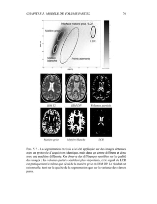 CHAPITRE 5. MODÈLE DE VOLUME PARTIEL 76
0.5
1
1.5
2
2.5
200 400 600 800 1000 1200 1400
800
900
1000
1100
1200
1300
1400
IRM T2
IRMDP
blanche
Matière
LCR
Points aberrants
Matière grise
Interface matière grise / LCR
log du nb de points
IRM T2 IRM DP Volumes partiels
Matière grise Matière blanche LCR
FIG. 5.7 – La segmentation en tissu a ici été appliquée sur des images obtenues
avec un protocole d’acquisition identique, mais dans un centre différent et donc
avec une machine différente. On observe des différences sensibles sur la qualité
des images : les volumes partiels semblent plus importants, et le signal du LCR
est pratiquement le même que celui de la matière grise en IRM DP. Le résultat est
raisonnable, tant sur la qualité de la segmentation que sur la variance des classes
pures.
 