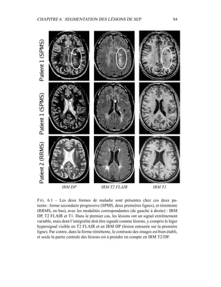 CHAPITRE 6. SEGMENTATION DES LÉSIONS DE SEP 84
IRM DP IRM T2 FLAIR IRM T1
FIG. 6.1 – Les deux formes de maladie sont présentes chez ces deux pa-
tients : forme secondaire progressive (SPMS, deux premières lignes), et rémittente
(RRMS, en bas), avec les modalités correspondantes (de gauche à droite) : IRM
DP, T2 FLAIR et T1. Dans le premier cas, les lésions ont un signal extrêmement
variable, mais dont l’intégralité doit être signalé comme lésions, y compris le léger
hypersignal visible en T2 FLAIR et en IRM DP (lésion entourée sur la première
ligne). Par contre, dans la forme rémittente, le contraste des images est bien établi,
et seule la partie centrale des lésions est à prendre en compte en IRM T2/DP.
 