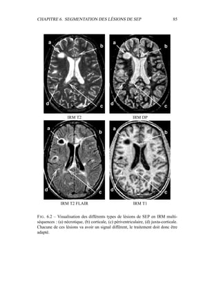 CHAPITRE 6. SEGMENTATION DES LÉSIONS DE SEP 85
IRM T2 IRM DP
IRM T2 FLAIR IRM T1
FIG. 6.2 – Visualisation des différents types de lésions de SEP en IRM multi-
séquences : (a) nécrotique, (b) corticale, (c) périventriculaire, (d) juxta-corticale.
Chacune de ces lésions va avoir un signal différent, le traitement doit donc être
adapté.
 