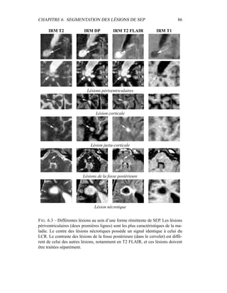 CHAPITRE 6. SEGMENTATION DES LÉSIONS DE SEP 86
IRM T2 IRM DP IRM T2 FLAIR IRM T1
Lésions périventriculaires
Lésion corticale
Lésion juxta-corticale
Lésions de la fosse postérieure
Lésion nécrotique
FIG. 6.3 – Différentes lésions au sein d’une forme rémittente de SEP. Les lésions
périventriculaires (deux premières lignes) sont les plus caractéristiques de la ma-
ladie. Le centre des lésions nécrotiques possède un signal identique à celui du
LCR. Le contraste des lésions de la fosse postérieure (dans le cervelet) est diffé-
rent de celui des autres lésions, notamment en T2 FLAIR, et ces lésions doivent
être traitées séparément.
 
