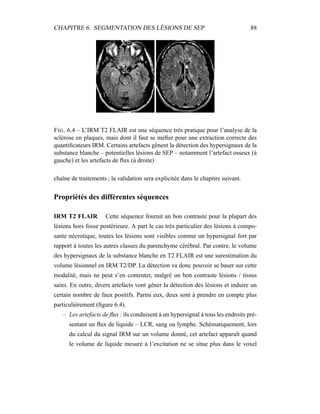 CHAPITRE 6. SEGMENTATION DES LÉSIONS DE SEP 88
FIG. 6.4 – L’IRM T2 FLAIR est une séquence très pratique pour l’analyse de la
sclérose en plaques, mais dont il faut se méﬁer pour une extraction correcte des
quantiﬁcateurs IRM. Certains artefacts gênent la détection des hypersignaux de la
substance blanche – potentielles lésions de SEP – notamment l’artefact osseux (à
gauche) et les artefacts de ﬂux (à droite)
chaîne de traitements ; la validation sera explicitée dans le chapitre suivant.
Propriétés des différentes séquences
IRM T2 FLAIR Cette séquence fournit un bon contraste pour la plupart des
lésions hors fosse postérieure. A part le cas très particulier des lésions à compo-
sante nécrotique, toutes les lésions sont visibles comme un hypersignal fort par
rapport à toutes les autres classes du parenchyme cérébral. Par contre, le volume
des hypersignaux de la substance blanche en T2 FLAIR est une surestimation du
volume lésionnel en IRM T2/DP. La détection va donc pouvoir se baser sur cette
modalité, mais ne peut s’en contenter, malgré un bon contraste lésions / tissus
sains. En outre, divers artefacts vont gêner la détection des lésions et induire un
certain nombre de faux positifs. Parmi eux, deux sont à prendre en compte plus
particulièrement (ﬁgure 6.4).
– Les artefacts de ﬂux : ils conduisent à un hypersignal à tous les endroits pré-
sentant un ﬂux de liquide – LCR, sang ou lymphe. Schématiquement, lors
du calcul du signal IRM sur un volume donné, cet artefact apparaît quand
le volume de liquide mesuré à l’excitation ne se situe plus dans le voxel
 