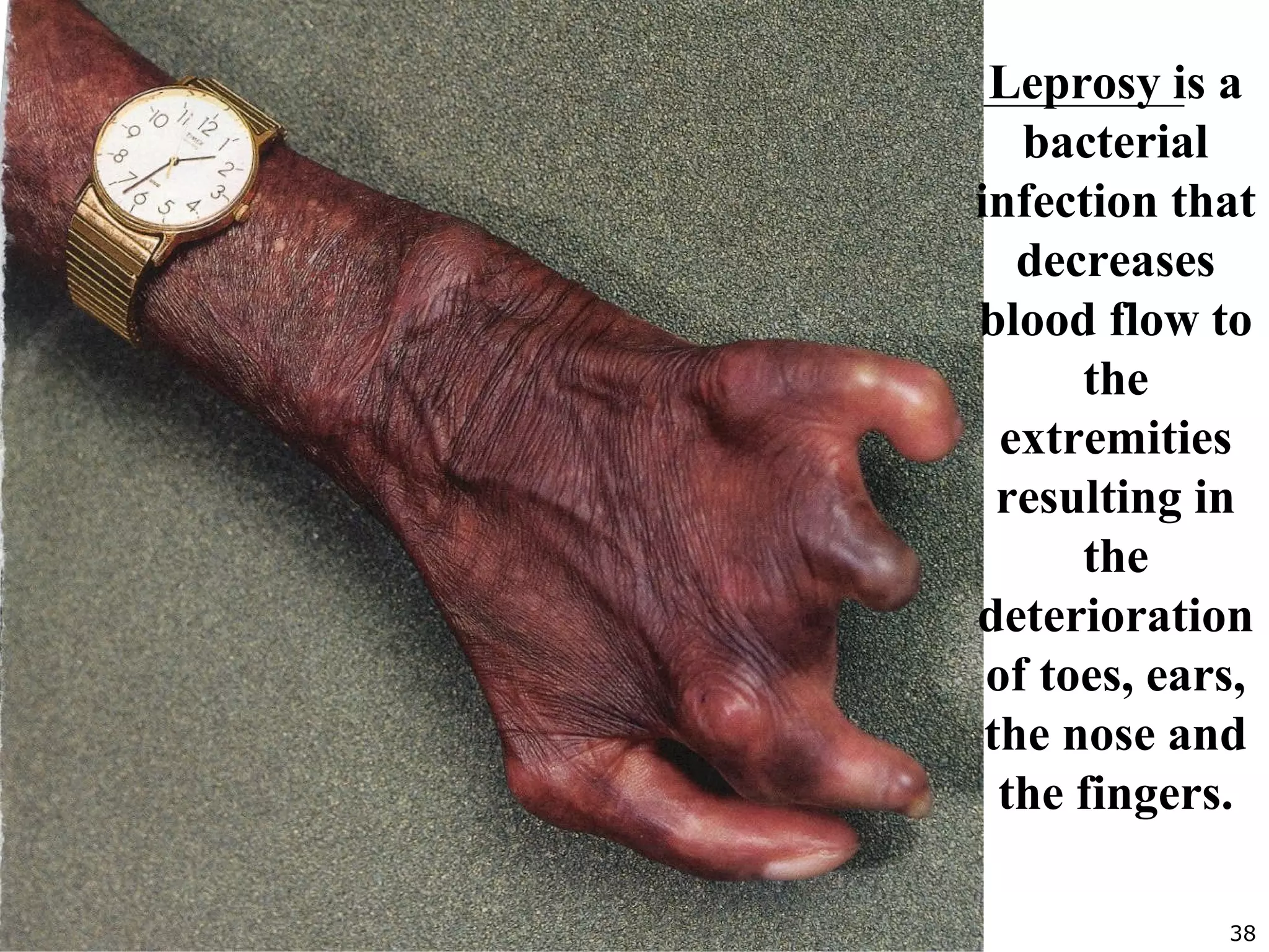 38
Leprosy is a
bacterial
infection that
decreases
blood flow to
the
extremities
resulting in
the
deterioration
of toes, ears,
the nose and
the fingers.
 