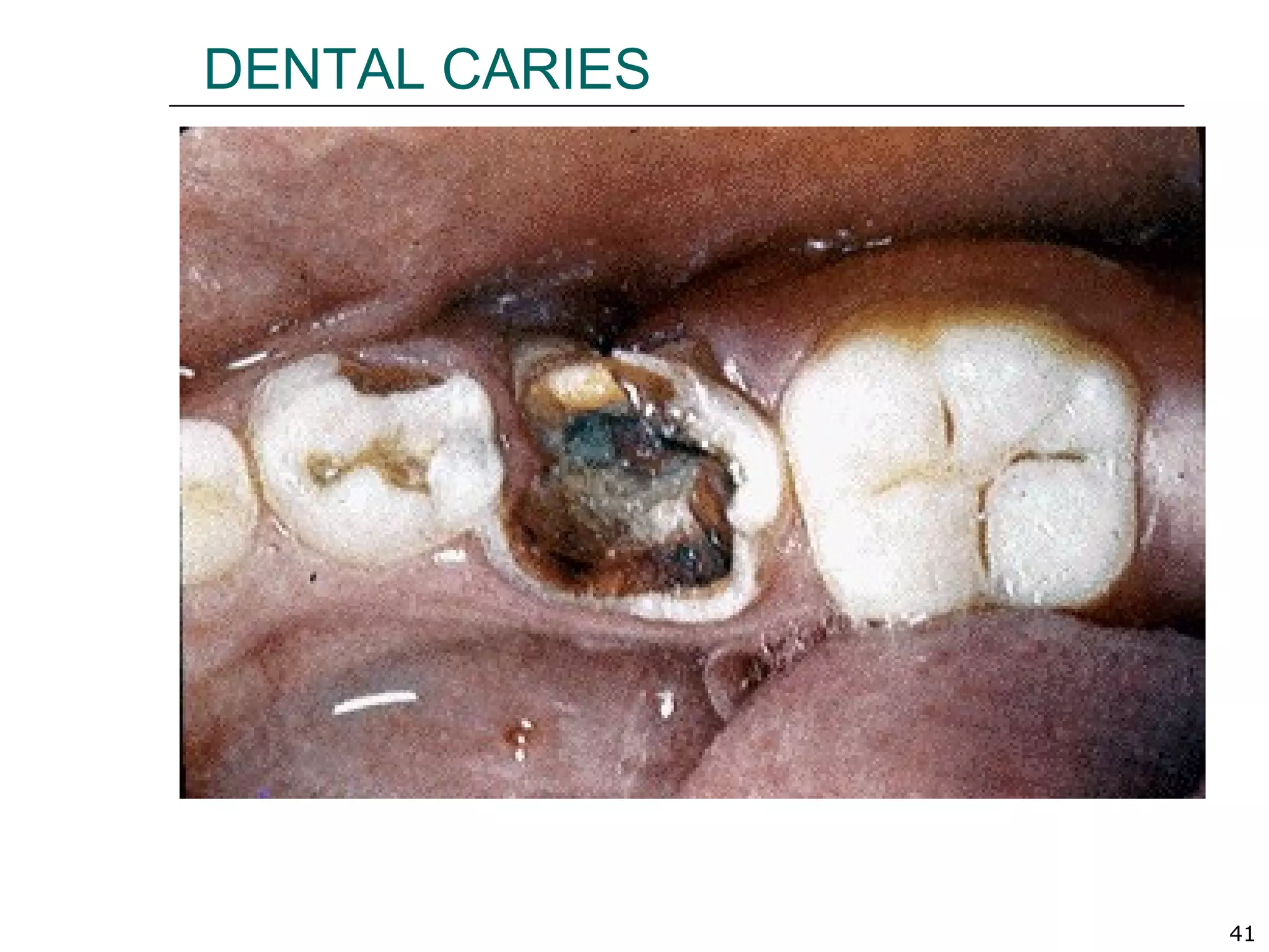 41
DENTAL CARIES
 
