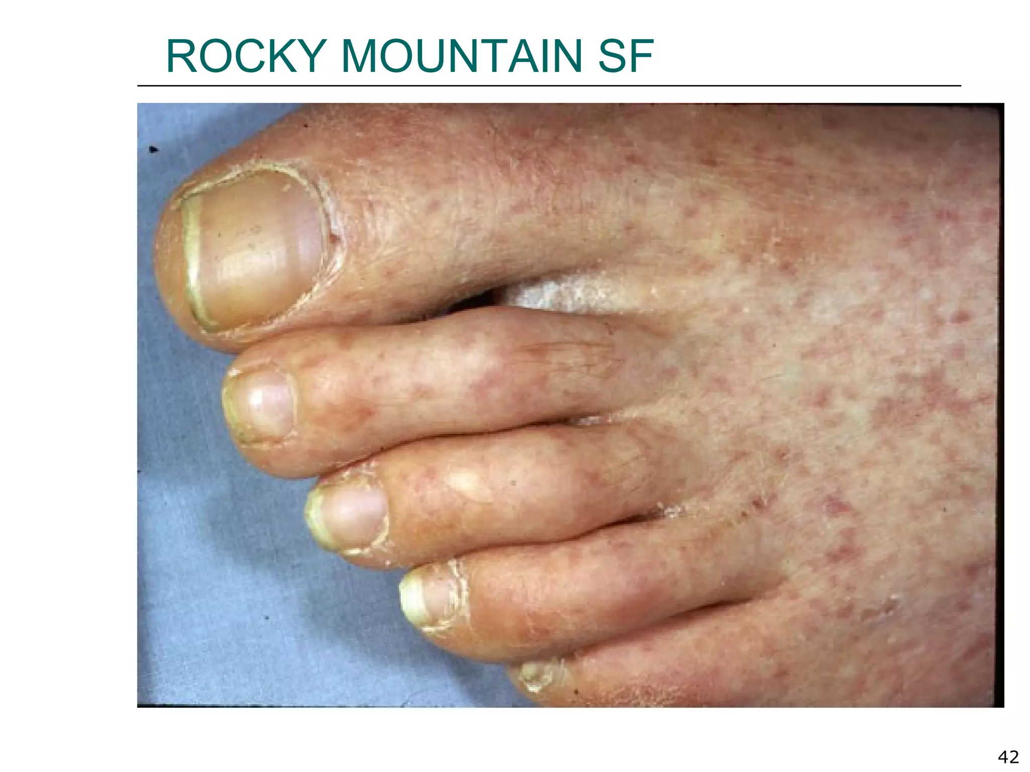 42
ROCKY MOUNTAIN SF
 