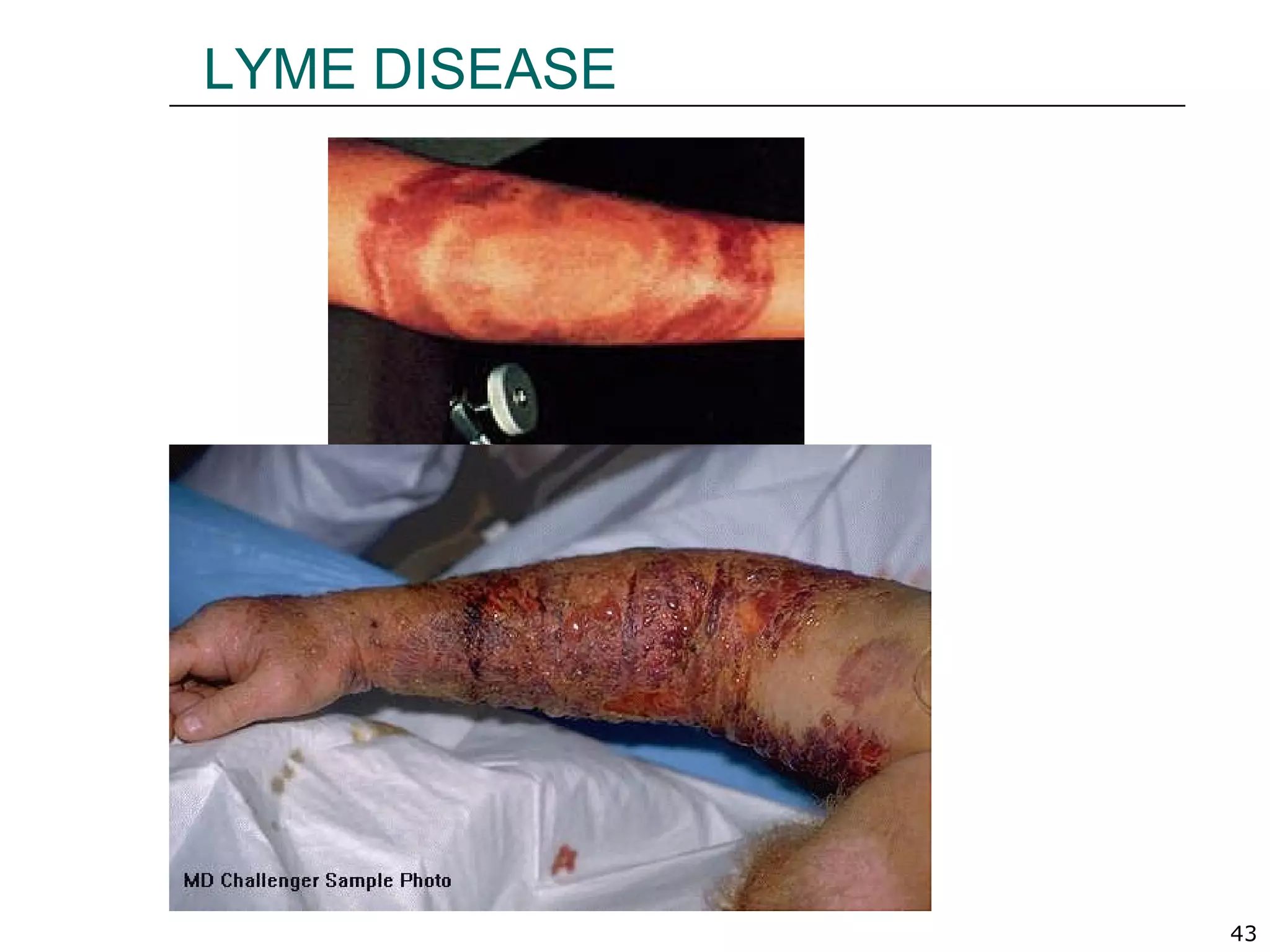 43
LYME DISEASE
 