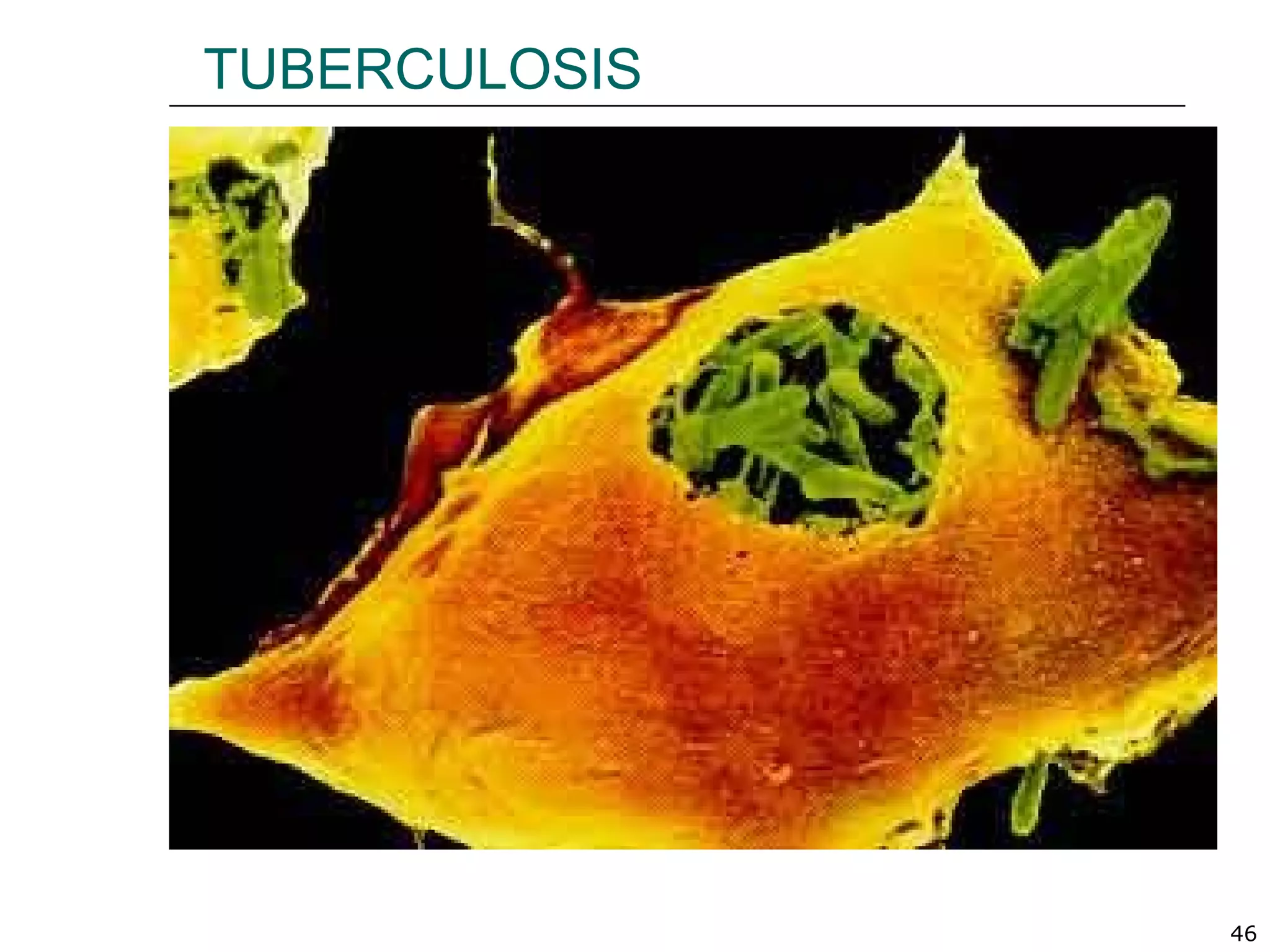 46
TUBERCULOSIS
 