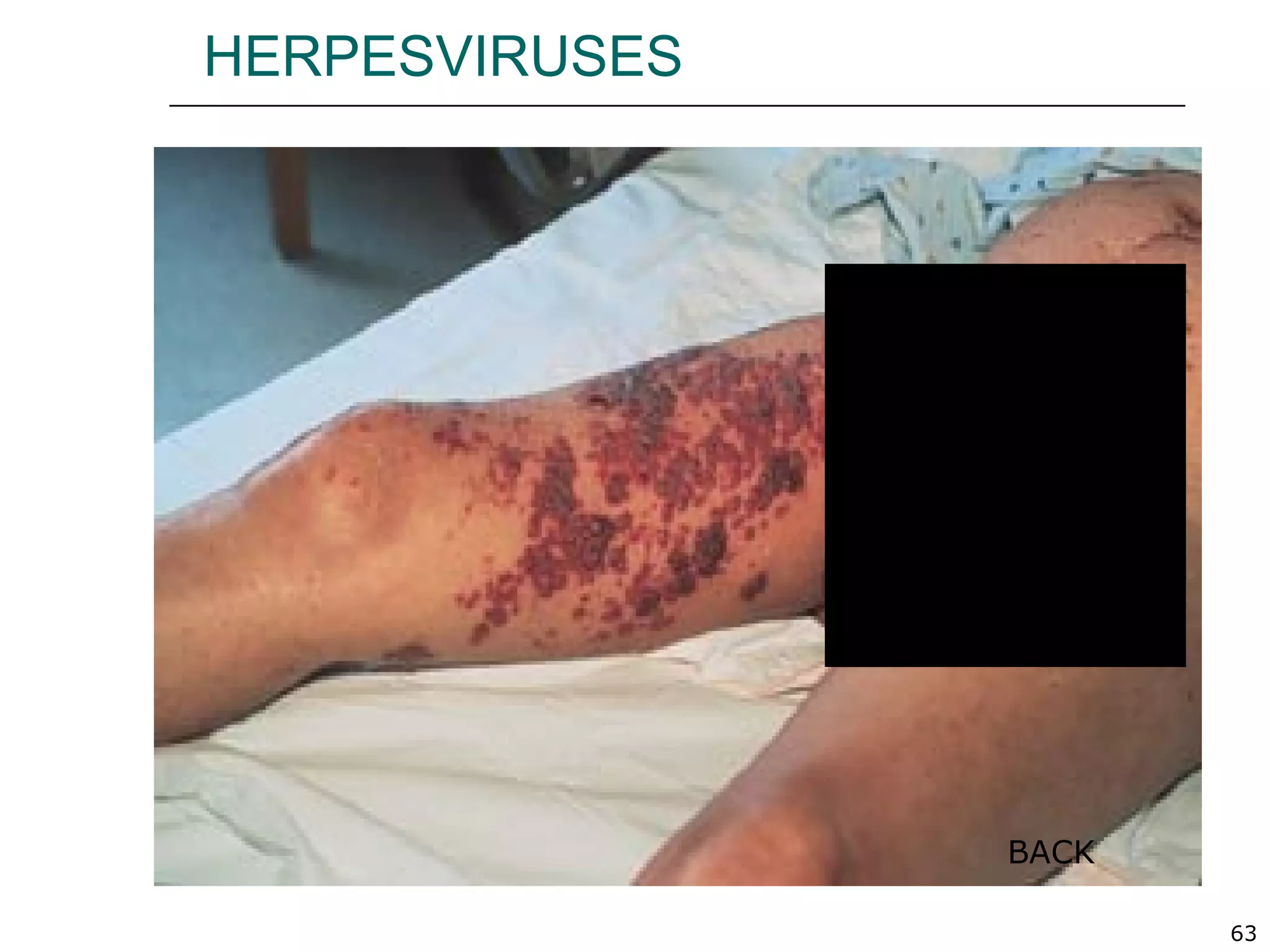 63
HERPESVIRUSES
BACK
 