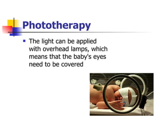 Phototherapy The light can be applied with overhead lamps, which means that the baby's eyes need to be covered  