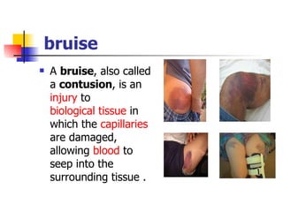 bruise A  bruise , also called a  contusion , is an  injury  to  biological tissue  in which the  capillaries  are damaged, allowing  blood  to seep into the surrounding tissue . 