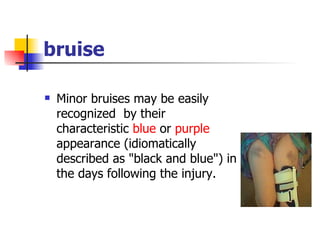 bruise Minor bruises may be easily recognized  by their characteristic  blue  or  purple  appearance (idiomatically described as "black and blue") in the days following the injury.  