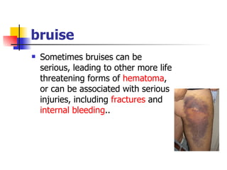bruise Sometimes bruises can be serious, leading to other more life threatening forms of  hematoma , or can be associated with serious injuries, including  fractures  and  internal bleeding ..  