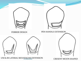 FERRIER DESIGN PEN HANDLE EXTENSION
UNI & BI LATERAL MOUSTACHE EXTENSION CRESENT MOON SHAPEDDr.MadhuBilla
 
