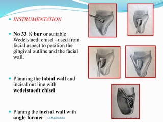  INSTRUMENTATION
 No 33 ½ bur or suitable
Wedelstaedt chisel –used from
facial aspect to position the
gingival outline and the facial
wall.
 Planning the labial wall and
incisal out line with
wedelstaedt chisel
 Planing the incisal wall with
angle former Dr.MadhuBilla
 
