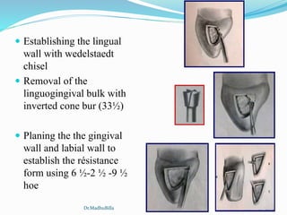  Establishing the lingual
wall with wedelstaedt
chisel
 Removal of the
linguogingival bulk with
inverted cone bur (33½)
 Planing the the gingival
wall and labial wall to
establish the résistance
form using 6 ½-2 ½ -9 ½
hoe
Dr.MadhuBilla
 