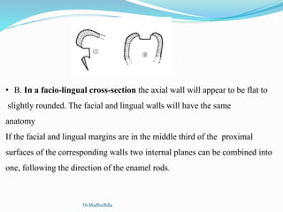 • B. In a facio-lingual cross-section the axial wall will appear to be flat to
slightly rounded. The facial and lingual walls will have the same
anatomy
If the facial and lingual margins are in the middle third of the proximal
surfaces of the corresponding walls two internal planes can be combined into
one, following the direction of the enamel rods.
Dr.MadhuBilla
 