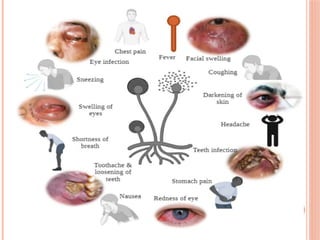 Title : DEEP FUNGAL INFECTIONS AND IT'S TYPES | PPTX