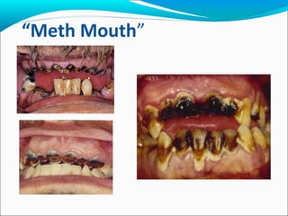“Meth Mouth”
 