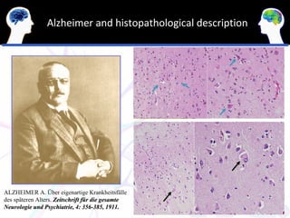 Alzheimer and histopathological description




ALZHEIMER A. Über eigenartige Krankheitsfälle
des späteren Alters. Zeitschrift für die gesamte
Neurologie und Psychiatrie, 4: 356-385, 1911.
 