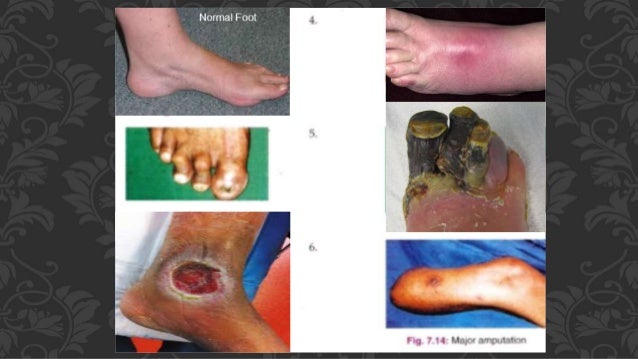 Diabetic Foot Sepsis