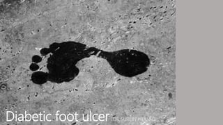 Diabetic foot ulcer DR SUREIN PRASAD
 