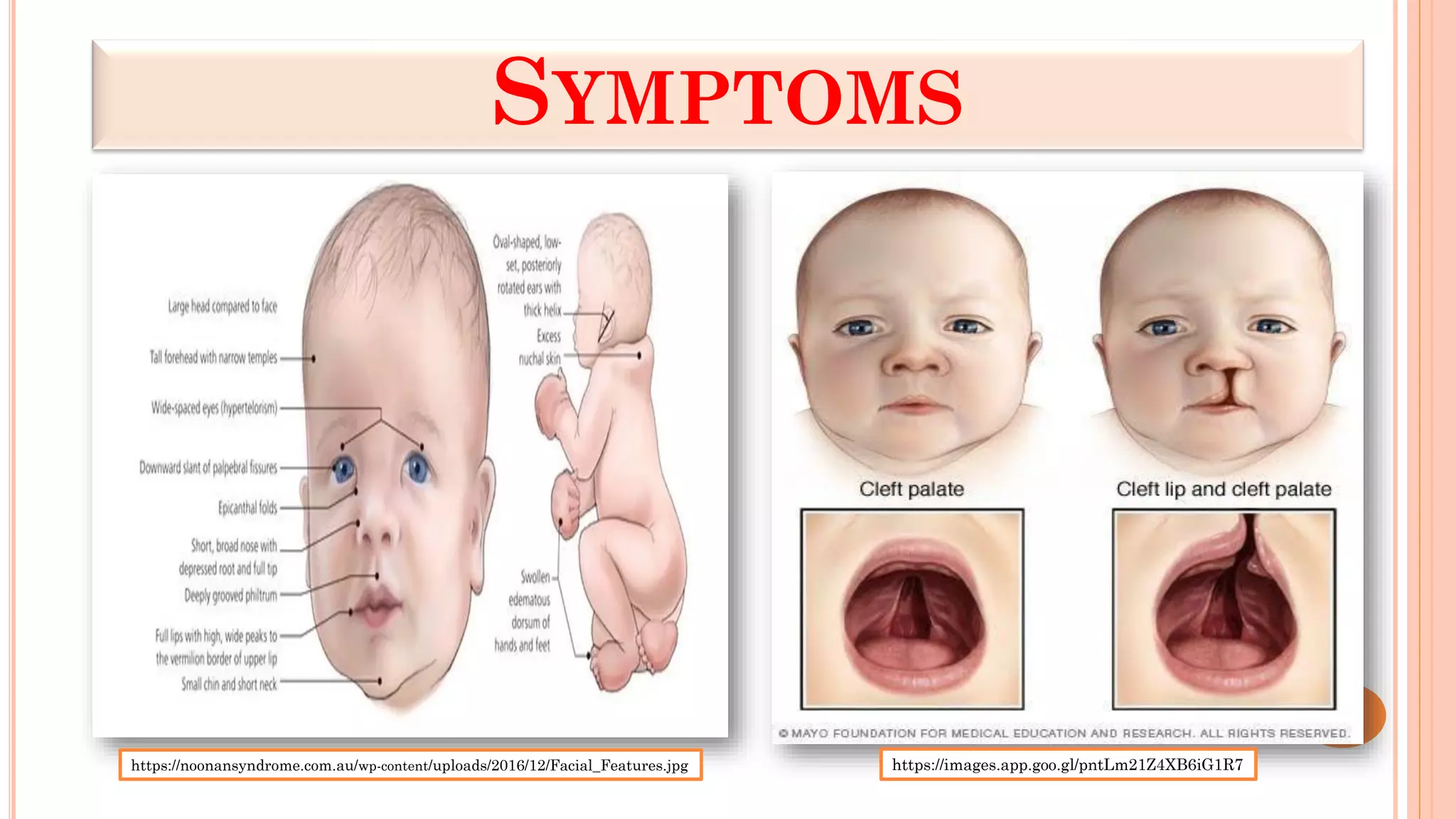 DiGeorge Syndrome (DGS).pdf