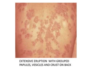 EXTENSIVE ERUPTION WITH GROUPED
PAPULES, VESICLES AND CRUST ON BACK
 