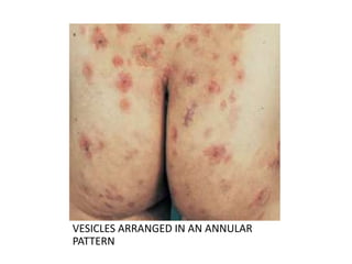 VESICLES ARRANGED IN AN ANNULAR
PATTERN
 