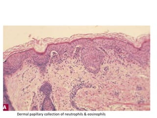 Dermal papillary collection of neutrophils & eosinophils
 