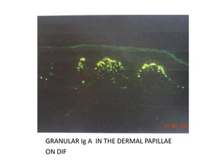 GRANULAR Ig A IN THE DERMAL PAPILLAE
ON DIF
 