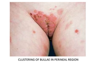 CLUSTERING OF BULLAE IN PERINEAL REGION
 