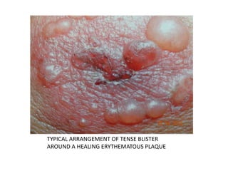 TYPICAL ARRANGEMENT OF TENSE BLISTER
AROUND A HEALING ERYTHEMATOUS PLAQUE
 