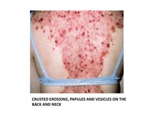 CRUSTED EROSIONS, PAPULES AND VESICLES ON THE
BACK AND NECK
 