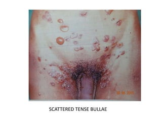 SCATTERED TENSE BULLAE
 