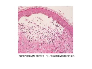 SUBEPIDERMAL BLISTER FILLED WITH NEUTROPHILS
 