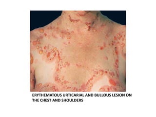 ERYTHEMATOUS URTICARIAL AND BULLOUS LESION ON
THE CHEST AND SHOULDERS
 