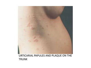 URTICARIAL PAPULES AND PLAQUE ON THE
TRUNK
 