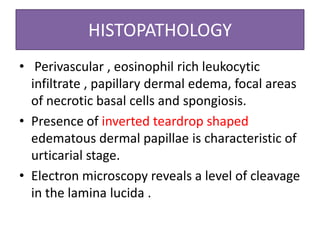 HISTOPATHOLOGY
• Perivascular , eosinophil rich leukocytic
infiltrate , papillary dermal edema, focal areas
of necrotic basal cells and spongiosis.
• Presence of inverted teardrop shaped
edematous dermal papillae is characteristic of
urticarial stage.
• Electron microscopy reveals a level of cleavage
in the lamina lucida .
 