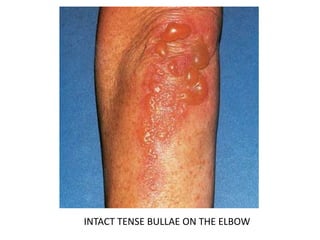 INTACT TENSE BULLAE ON THE ELBOW
 