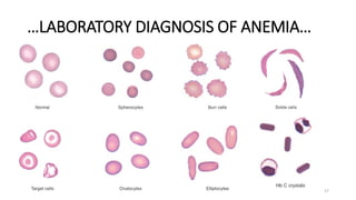 DH2 Unit 02 Anaemias Red Blood Cell Morphology and Approach to ...