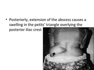 • Posteriorly, extension of the abscess causes a
swelling in the petits’ triangle overlying the
posterior iliac crest
 
