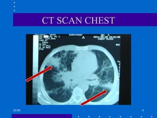 CT SCAN CHEST 03/00 