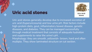 Uric acid stones
Uric acid stones generally develop due to increased excretion of
uric acid (hyperuricosuria) and low urine pH. Risk factors include
high-protein diets, gout, inﬂammatory bowel disease, genetic
diseases, and diabetes. They can be managed successfully
through medical treatment that consists of adequate hydration
and supplements to raise the urine’s pH.
Morphology: they are smooth, yellowish– brown, hard and often
multiple. They show laminated structure on cut section.
 