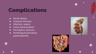 ● Renal failure
● Ureteral stricture
● Infection, sepsis
● Urine extravasation
● Perinephric abscess
● Xanthogranulomatous
pyelonephritis
Complications
 