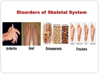 Disorders of Skeletal System
 